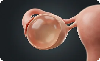 난소낭종 치료 안내