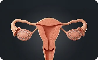 다낭성 난소 증후군 안내