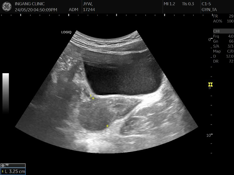 30대 초반 난소 자궁내막종 수술 후 몸살과 잔존 생리통 치료 사례