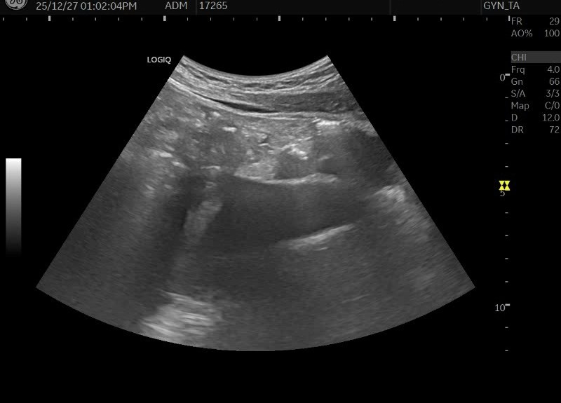 30대 중후반 여성의 극심한 생리통과 겨울철 복부 통증 치료 사례