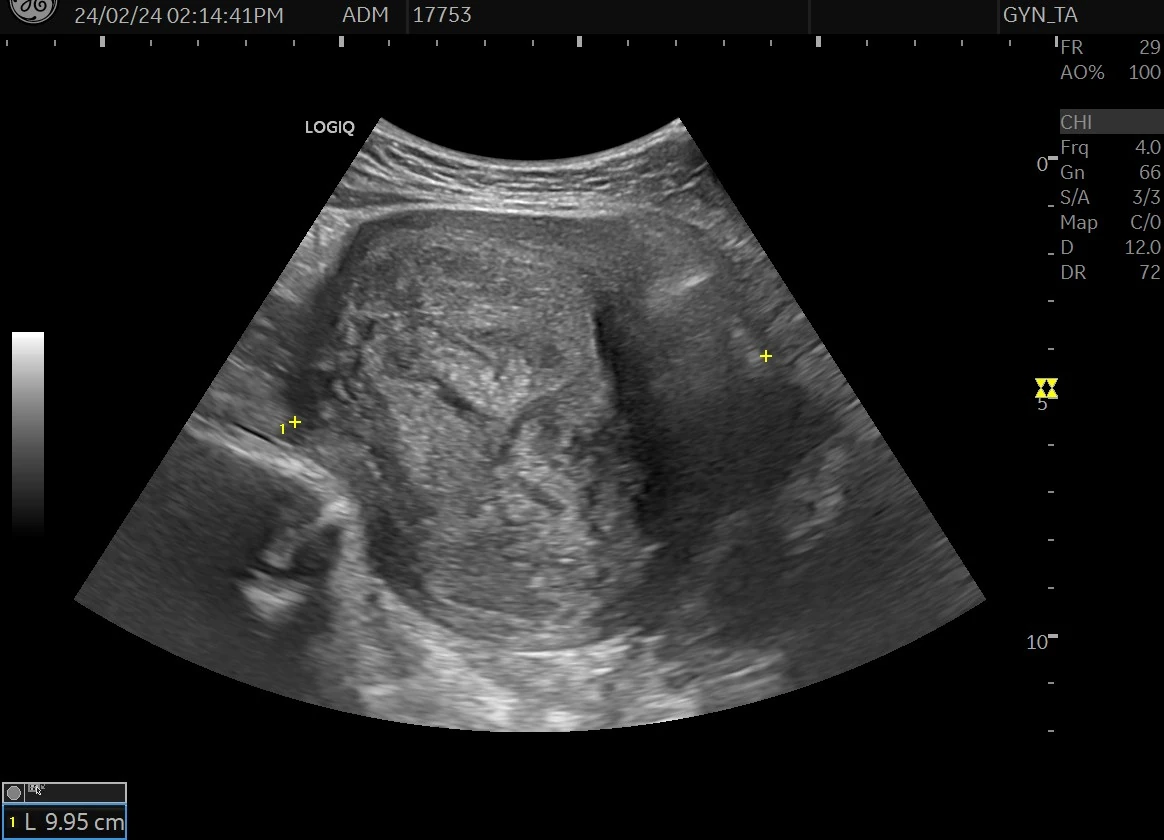 30대 후반 여성의 약 10cm 자궁근종 크기 감소 치료 사례