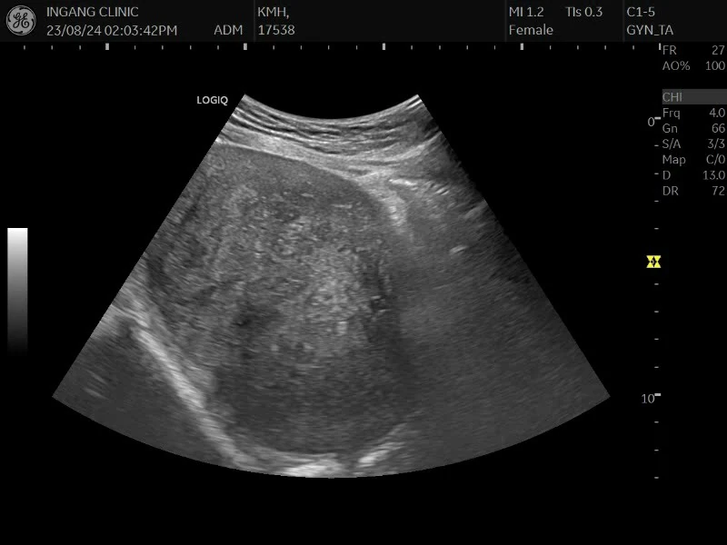 40대 후반 여성의 11cm 거대 자궁선근증으로 인한 심한 배뇨장애 치료 사례