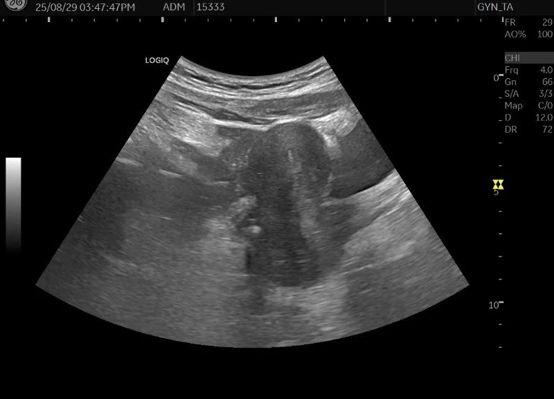 30대 후반 만성 질염과 생리불순 치료 사례