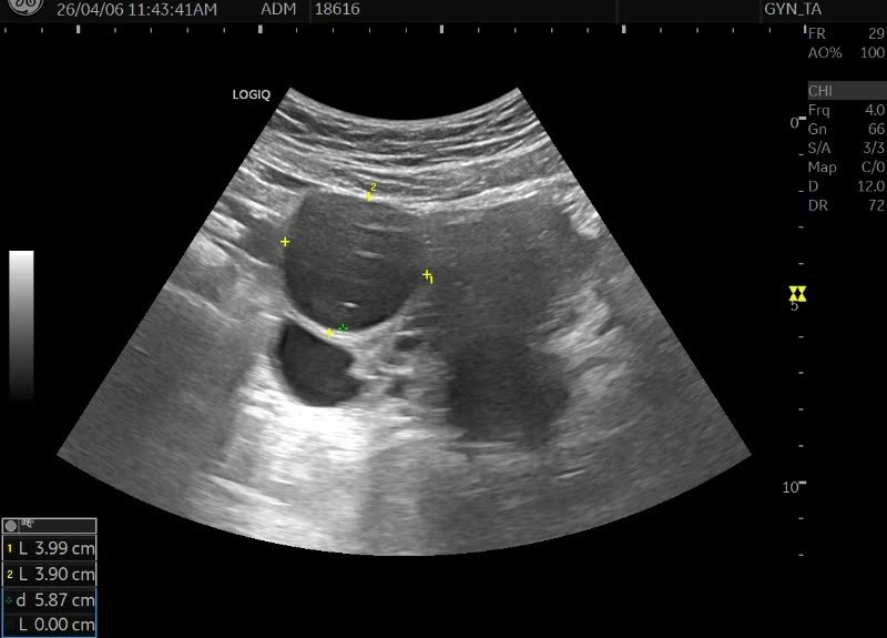 40대 초반 여성의 있었는데 없어진 4cm 난소 물혹 치료 사례